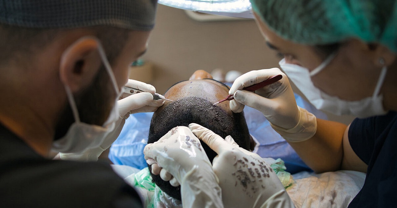 Kosten für Haartransplantation und Pflege in der Türkei und erforderliche Genehmigungen
